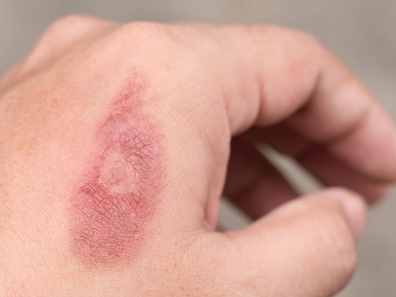 Queimaduras: o que você precisa saber sobre cuidados e prevenção
